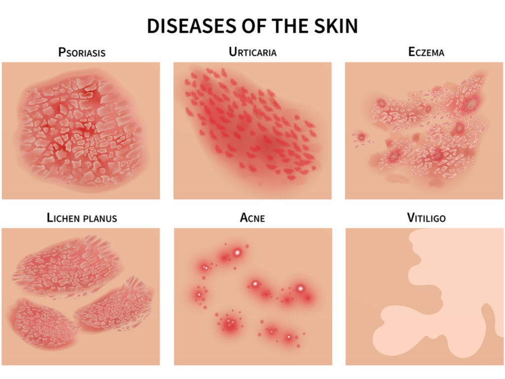 Skin Disease त्वचा रोग